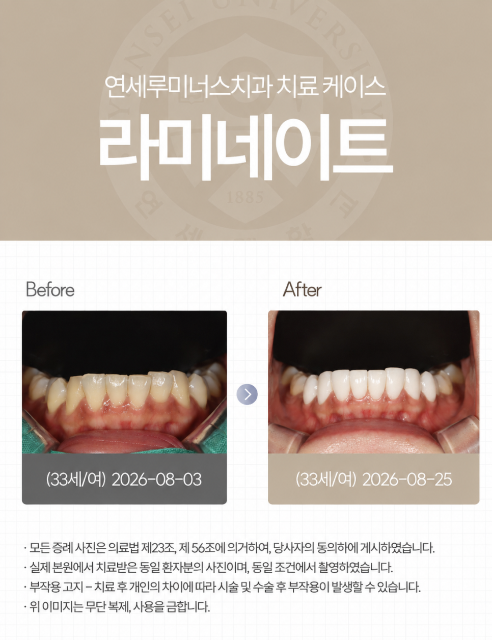 강남라미네이트 / 치아의 손상은 줄이고, 자연스러움은 더하는 방법 관련 이미지 6