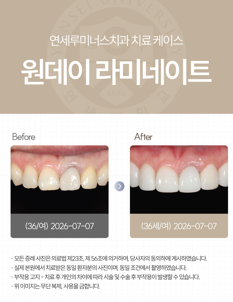 강남라미네이트 치료사례 ― 강원도 원주에서 찾아오신 라미네이트 + 2차충치 관련 이미지 1