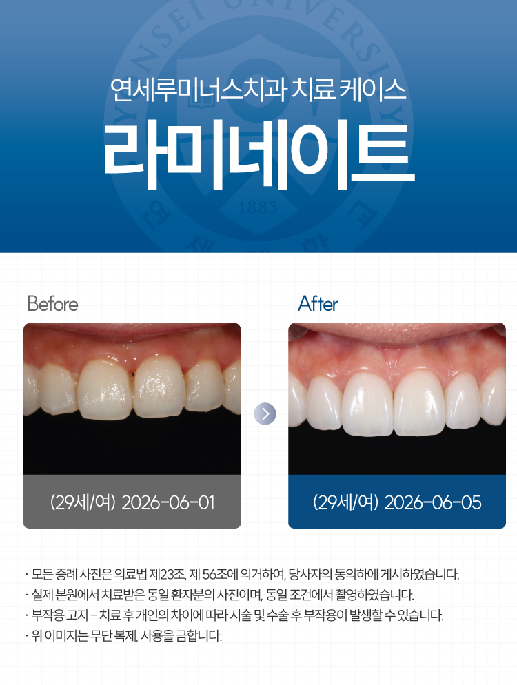 강남라미네이트 수복증례 ― 치아 표면의 석회화 반점 관련 이미지 1
