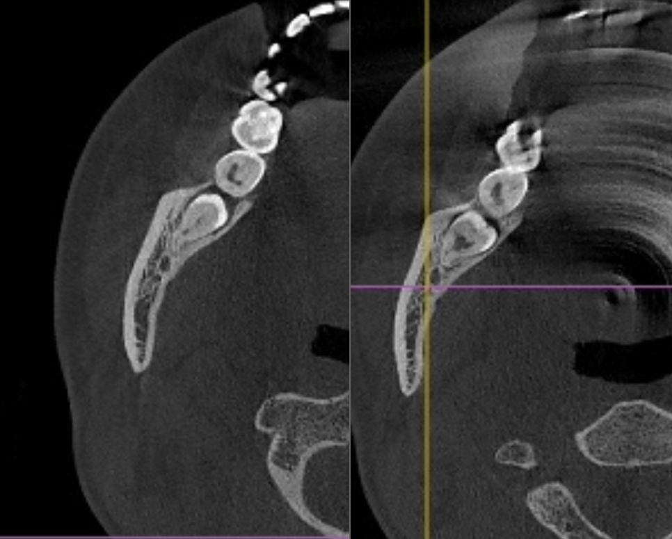 There Was a Wisdom Tooth.... Now It’s Gone!! image 2