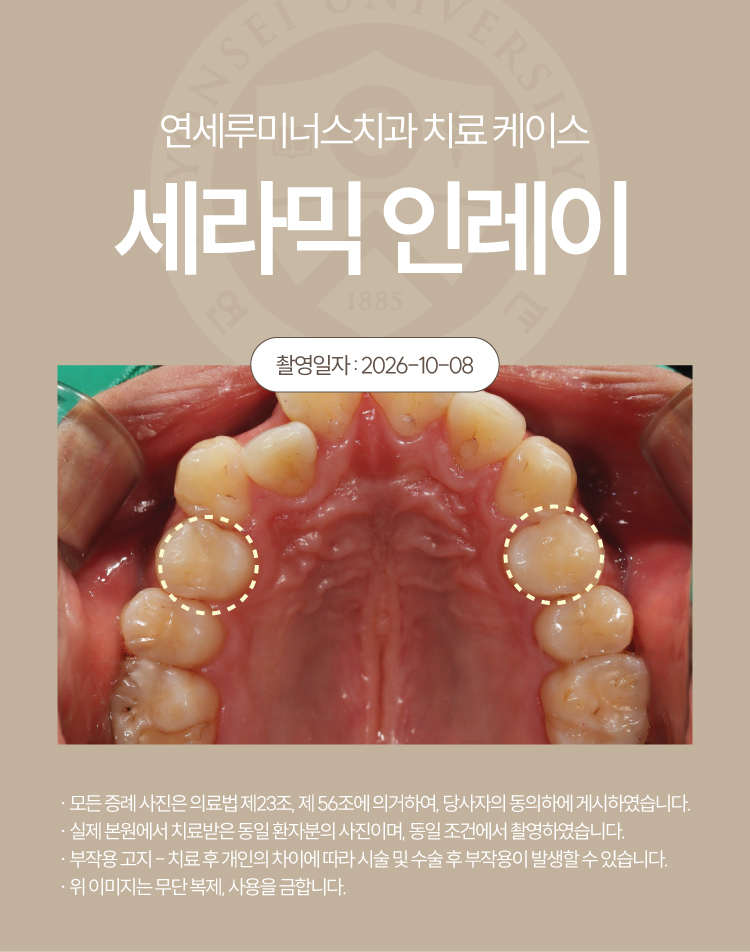 강남충치치료 케이스 : 직장동료 추천으로 내원한 20대 남성, 4개 세라믹 인레이 관련 이미지 4