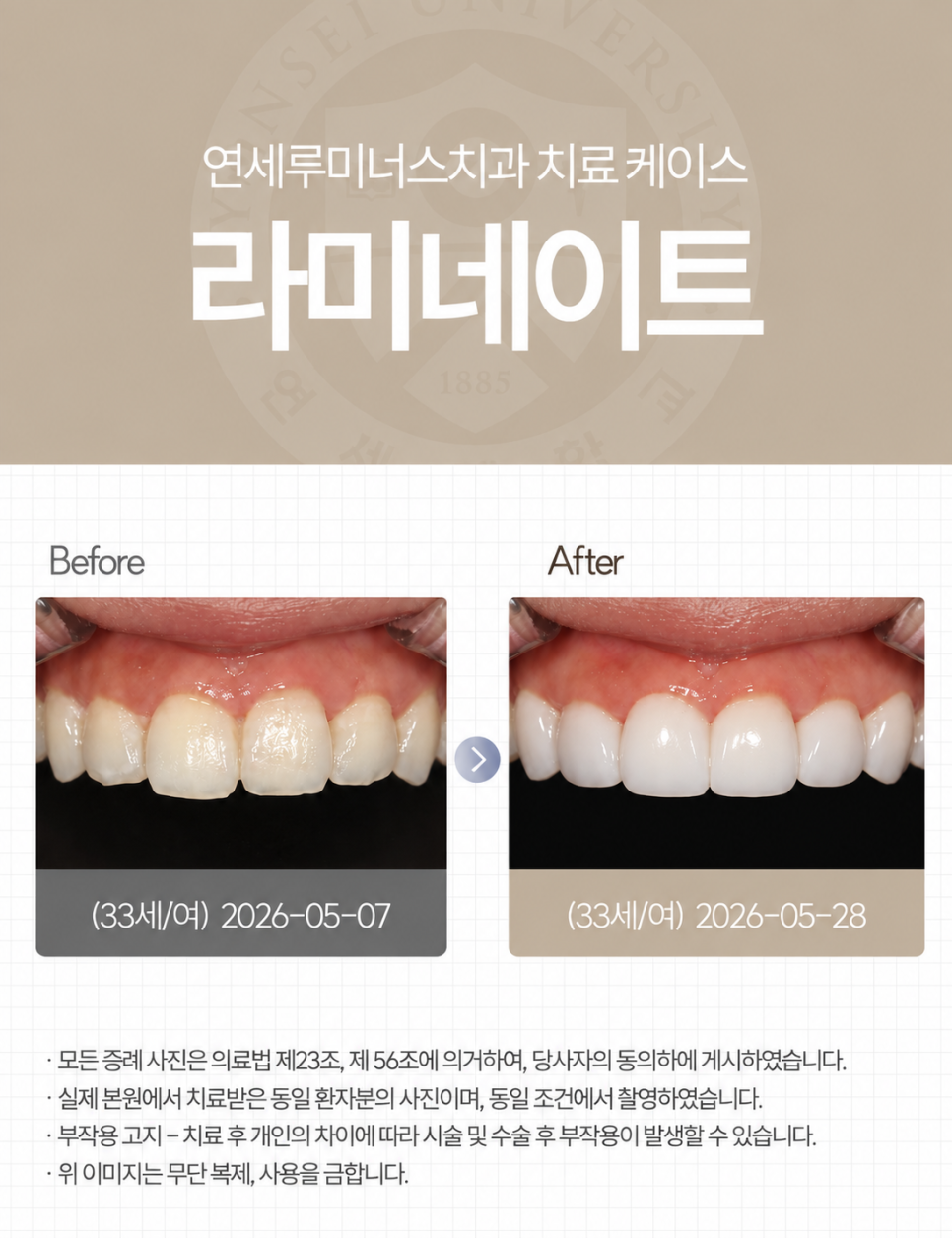 최소한의 치아 삭제로 완성한 자연스러운 강남라미네이트! 관련 이미지 1