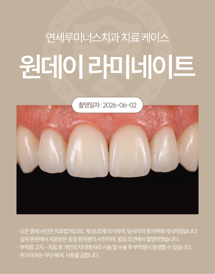강남원데이라미네이트 치료사례 ― 색상, 라인 개선 (37세/남환자) 관련 이미지 3