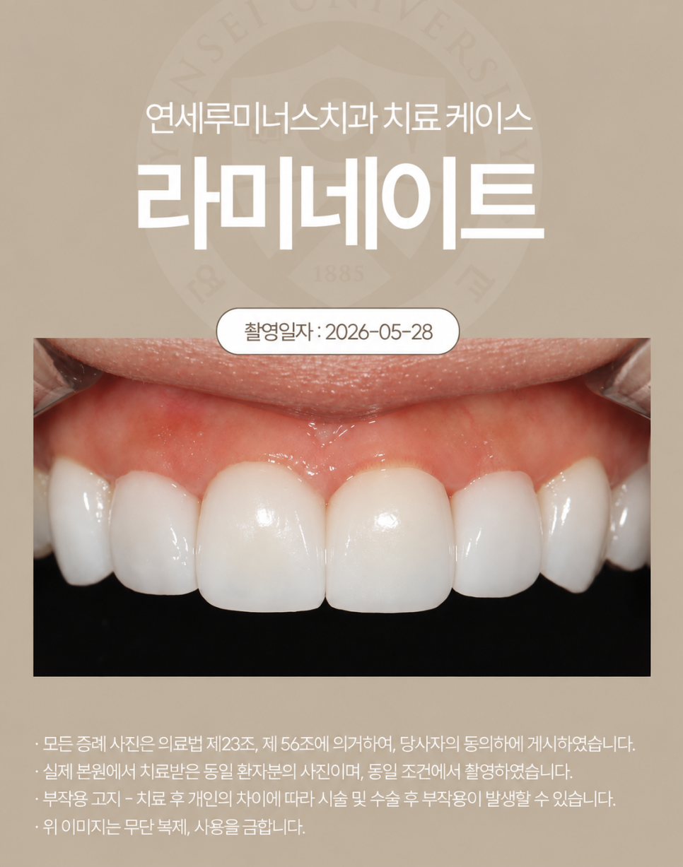 최소한의 치아 삭제로 완성한 자연스러운 강남라미네이트! 관련 이미지 3