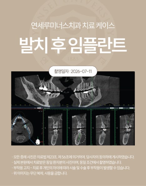 강남발치후임플란트 사례 ― 좌측 상하악 다발성 발치 및 즉시 임플란트 식립 (52세/남환자) 관련 이미지 6