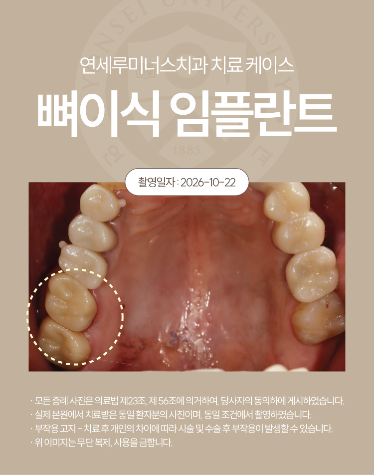 강남신경치료 케이스 : 사랑니까지 살린 17, 18번 치근단염 치료 (터키에서 오신 외국인 환자분!) 관련 이미지 8