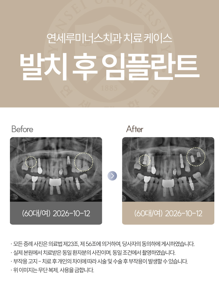 강남역임플란트 케이스 : 치관부 파절 및 치주 염증으로 발치 후 식립한 60대 여성 증례 관련 이미지 1