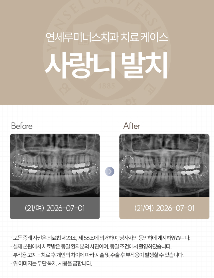 Gangnam Station Wisdom Tooth Extraction Case ― Simultaneous Extraction of Three Wisdom Teeth (21-Year-Old Female Patient) image 1
