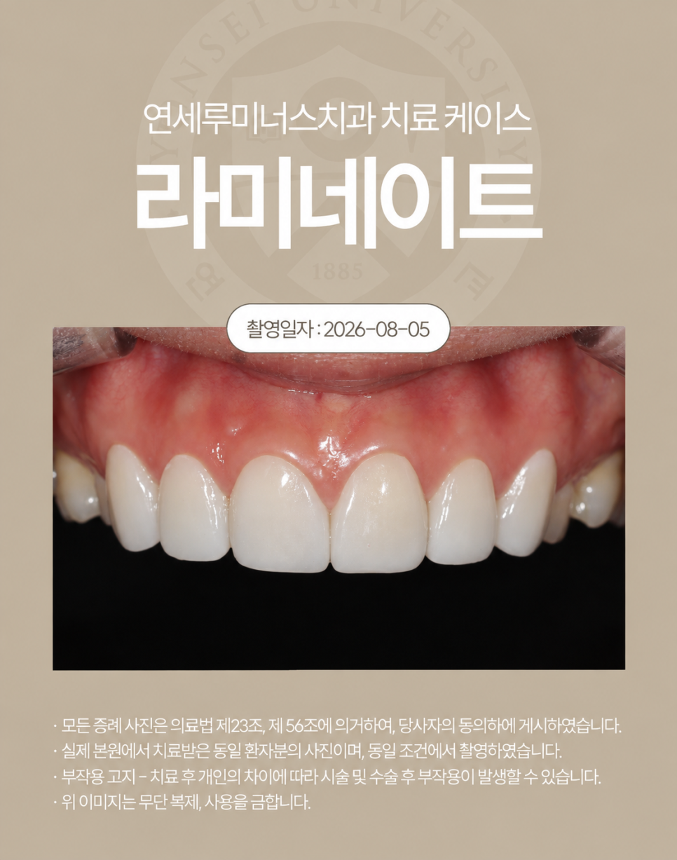 강남라미네이트 / 오래된 앞니 레진 변색, 라미네이트가 가능할까? 관련 이미지 3