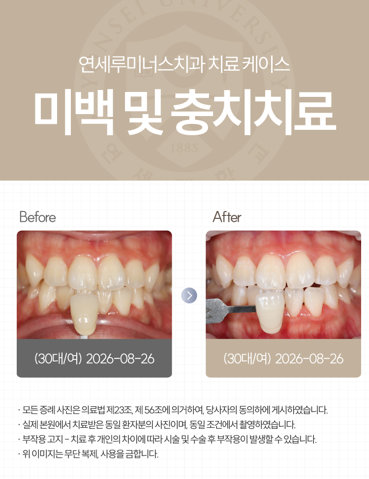 강남역치아미백 케이스 : 미백 중 발견한 충치까지 함께! (30대/여환자) 관련 이미지 4