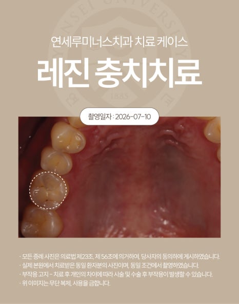 강남충치치료 사례 ― 충치 레진 충전 케이스 (37세/여환자/호주 외국인) 관련 이미지 2
