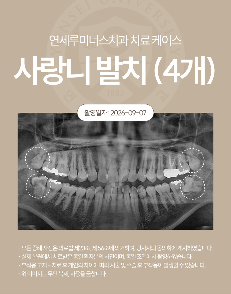 강남역사랑니발치, 4개 하루 만에 동시 발치 가능할까요? 관련 이미지 4