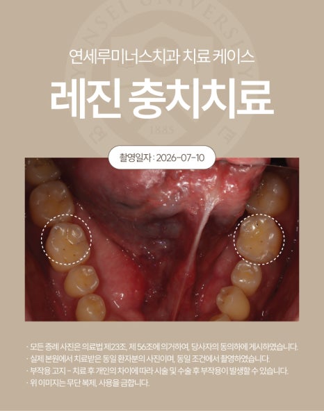 강남충치치료 사례 ― 충치 레진 충전 케이스 (37세/여환자/호주 외국인) 관련 이미지 3
