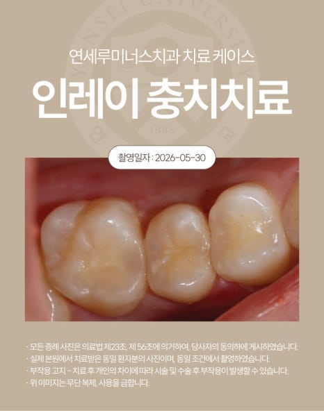 강남충치치료 사례 ― 좌측 어금니 통증으로 발견(28세/남환자) 관련 이미지 4
