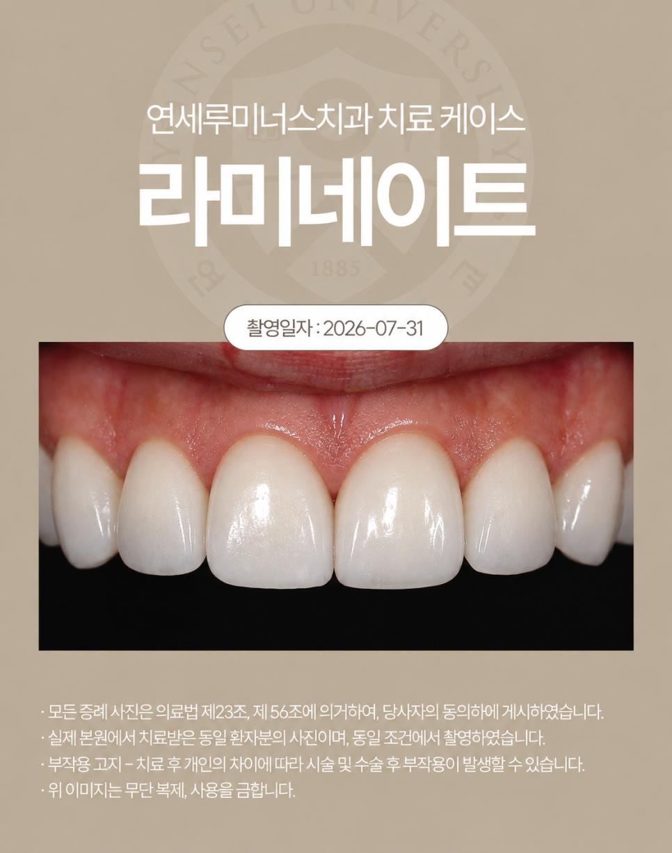 강남라미네이트 / 치아의 손상은 줄이고, 자연스러움은 더하는 방법 관련 이미지 3