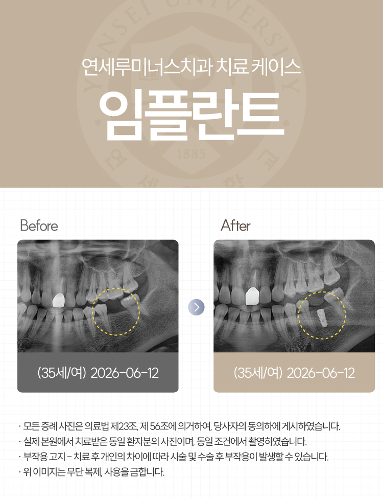 강남역임플란트 치료사례 ― 하악 임플란트 (35세/여환자) 관련 이미지 1