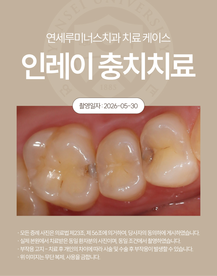 강남충치치료 사례 ― 좌측 어금니 통증으로 발견(28세/남환자) 관련 이미지 2