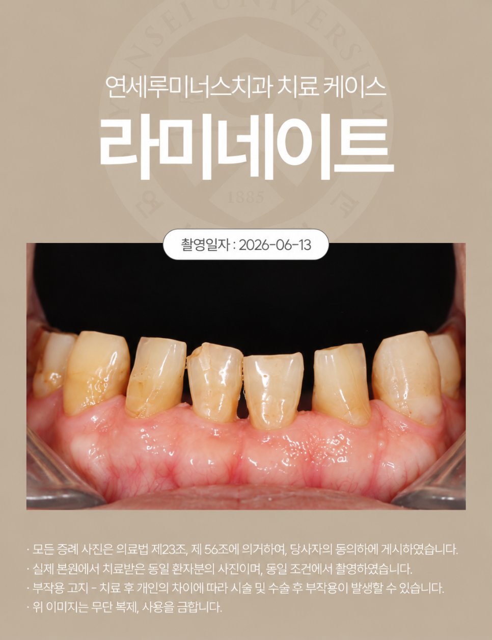 심하게 마모된 치아, 라미네이트로 회복할 수 있을까? 관련 이미지 4
