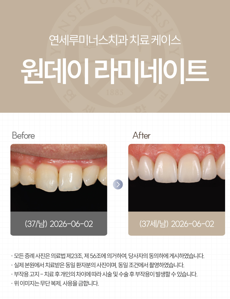 강남원데이라미네이트 치료사례 ― 색상, 라인 개선 (37세/남환자) 관련 이미지 1