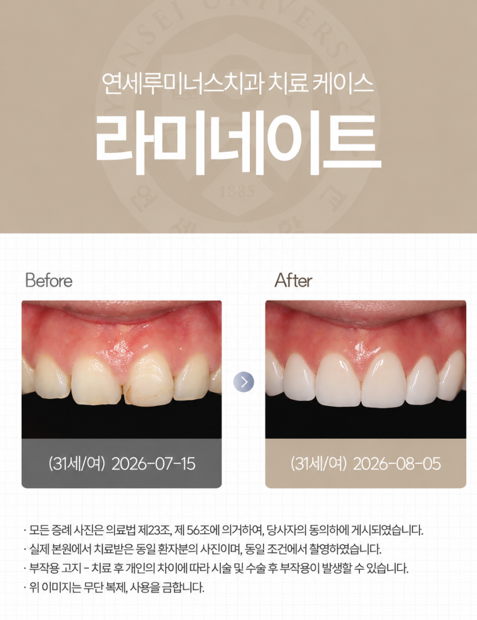 강남라미네이트 / 오래된 앞니 레진 변색, 라미네이트가 가능할까? 관련 이미지 1