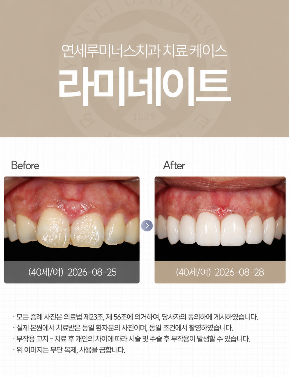 강남라미네이트 / 삐뚤어진 치아도 깔끔하게 변신! 관련 이미지 1