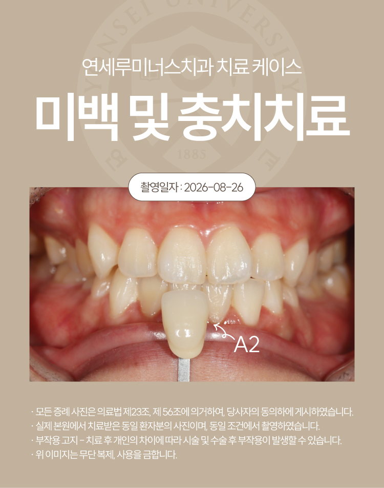 강남역치아미백 케이스 : 미백 중 발견한 충치까지 함께! (30대/여환자) 관련 이미지 5