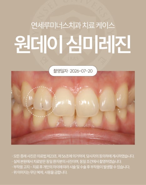 강남심미레진 치료사례 ― #12 앞니 심미레진 원데이 케이스 (30세/여환자) 관련 이미지 2