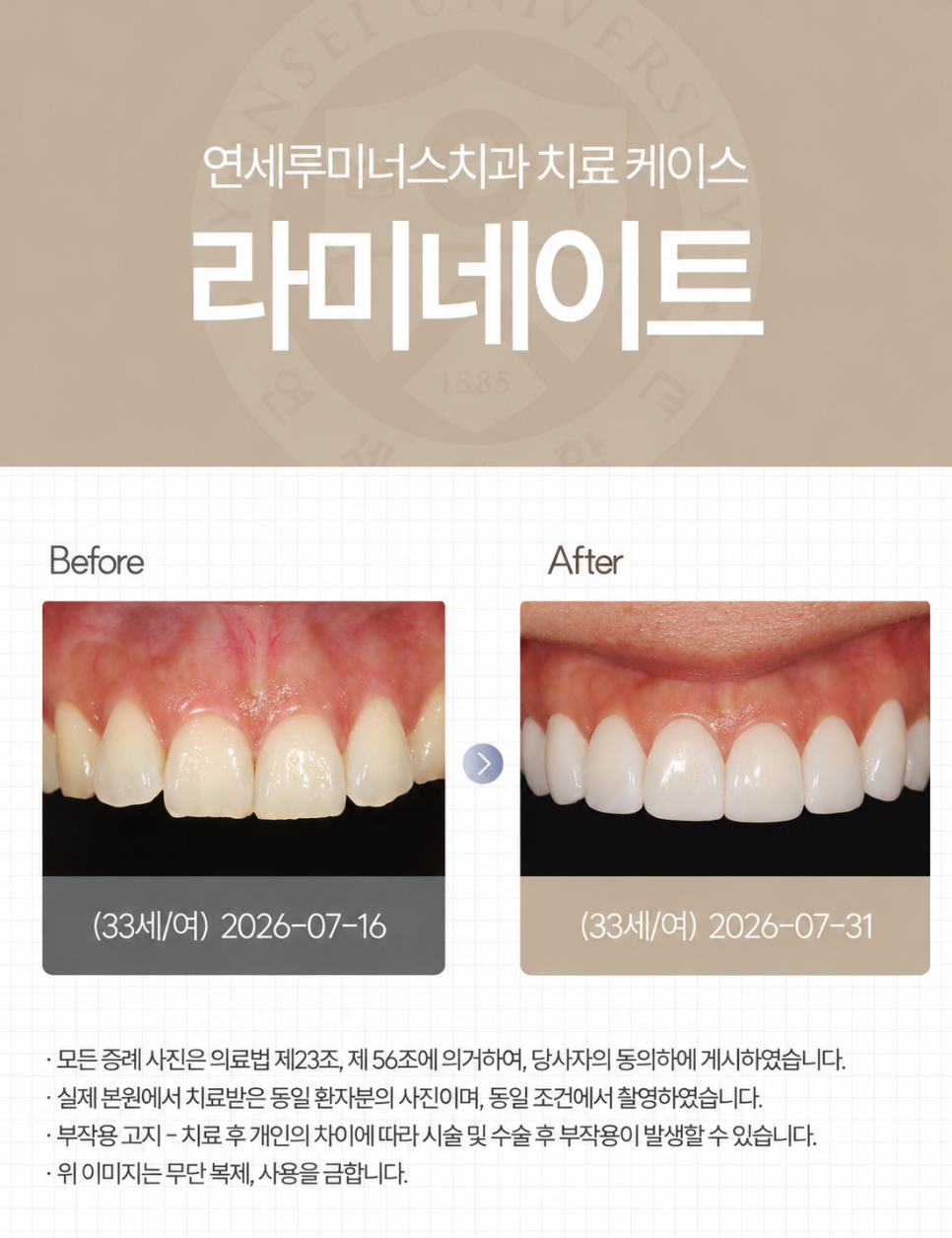 강남라미네이트 / 치아의 손상은 줄이고, 자연스러움은 더하는 방법 관련 이미지 1