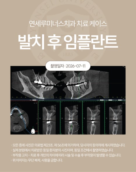 강남발치후임플란트 사례 ― 좌측 상하악 다발성 발치 및 즉시 임플란트 식립 (52세/남환자) 관련 이미지 7