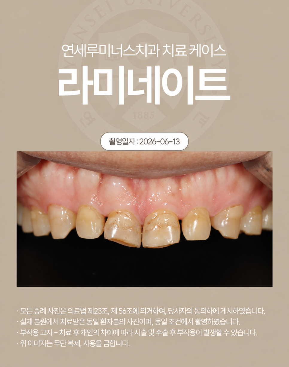 심하게 마모된 치아, 라미네이트로 회복할 수 있을까? 관련 이미지 2