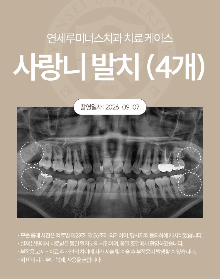 강남역사랑니발치, 4개 하루 만에 동시 발치 가능할까요? 관련 이미지 5