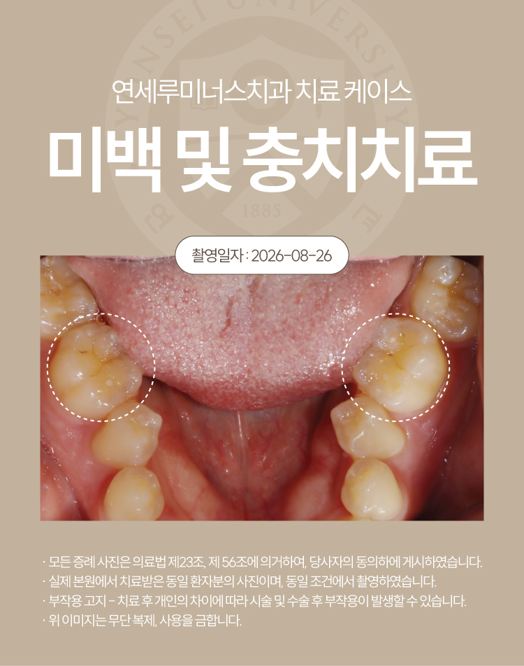 강남역치아미백 케이스 : 미백 중 발견한 충치까지 함께! (30대/여환자) 관련 이미지 2