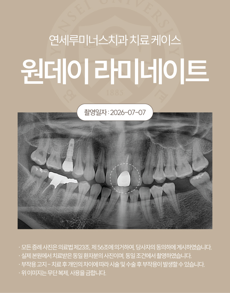 강남라미네이트 치료사례 ― 강원도 원주에서 찾아오신 라미네이트 + 2차충치 관련 이미지 2