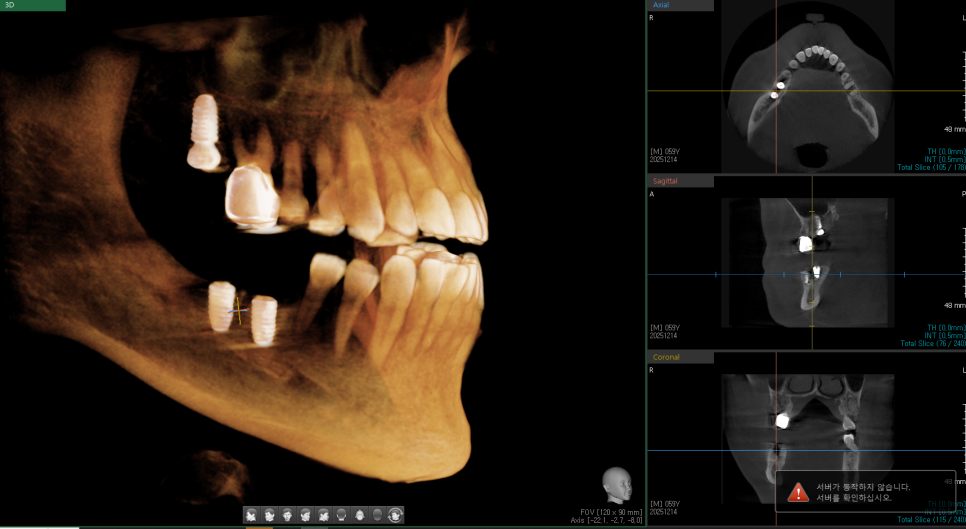 이전에 수술했던 임플란트 케이스 공유합니다! 관련 이미지 2