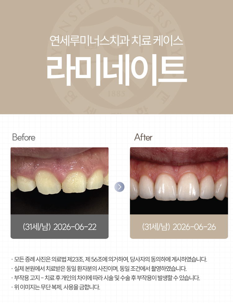강남역라미네이트 수복증례 ― 치료 케이스 (31세/남환자) 관련 이미지 1