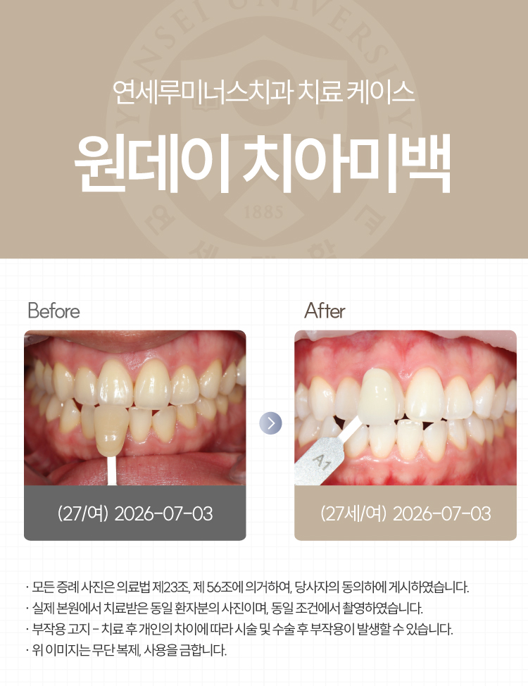 강남역원데이치아미백 치료사례 ― 원데이 치아미백 케이스 (27세/여환자) 관련 이미지 1
