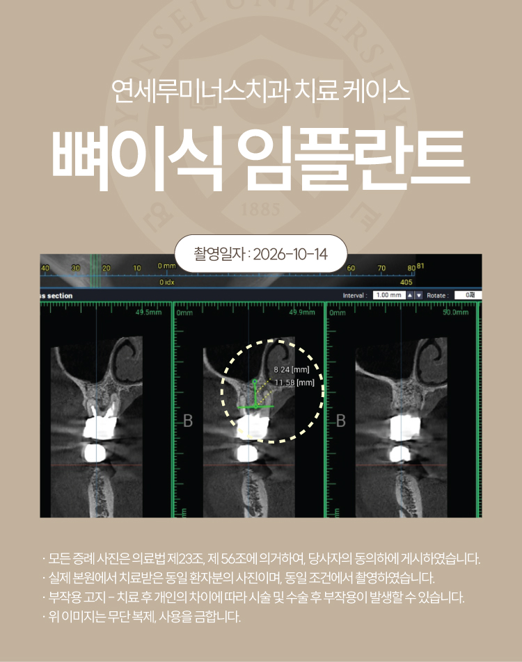 강남발치후임플란트 케이스 : 오른쪽 위 잇몸 붓기로 발견한 뿌리 염증, 발치 후 식립 관련 이미지 4