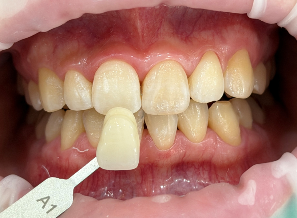 Teeth Whitening Again Today~~ image 2
