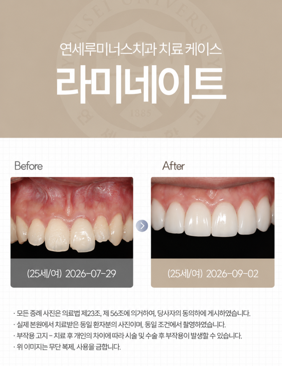 강남 라미네이트 / 깨진 앞니 고민을 자연스럽게 개선한 사례 관련 이미지 1