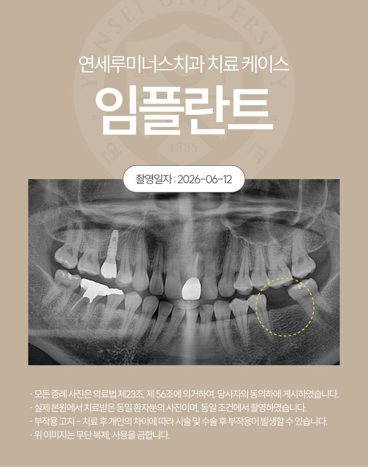 강남역임플란트 치료사례 ― 하악 임플란트 (35세/여환자) 관련 이미지 2