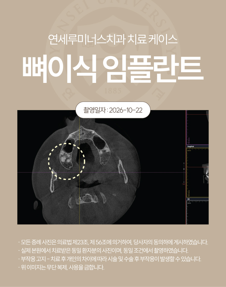 강남신경치료 케이스 : 사랑니까지 살린 17, 18번 치근단염 치료 (터키에서 오신 외국인 환자분!) 관련 이미지 4