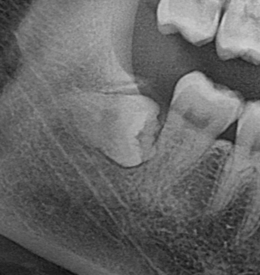 There Was a Wisdom Tooth.... Now It’s Gone!! image 1