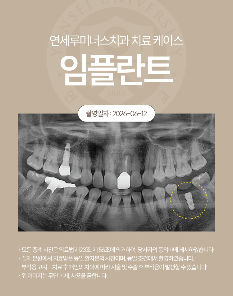 강남역임플란트 치료사례 ― 하악 임플란트 (35세/여환자) 관련 이미지 3