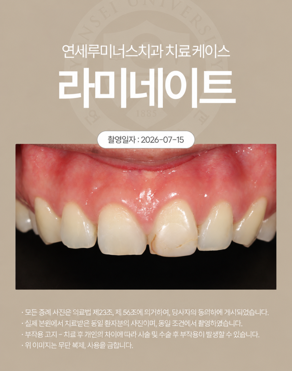 강남라미네이트 / 오래된 앞니 레진 변색, 라미네이트가 가능할까? 관련 이미지 2
