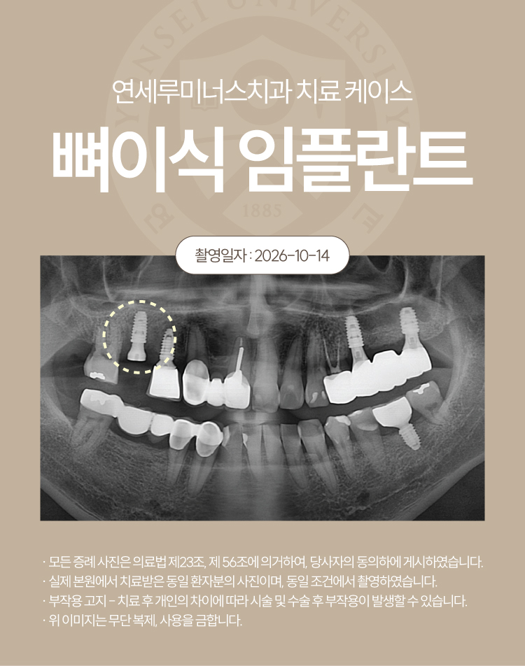 강남발치후임플란트 케이스 : 오른쪽 위 잇몸 붓기로 발견한 뿌리 염증, 발치 후 식립 관련 이미지 5