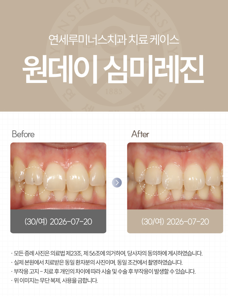 강남심미레진 치료사례 ― #12 앞니 심미레진 원데이 케이스 (30세/여환자) 관련 이미지 1