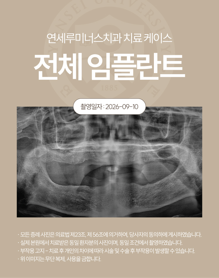 강남전체임플란트 케이스 : 제주도에서 찾아오신 무치악 환자, 당일 식립 완료 관련 이미지 2