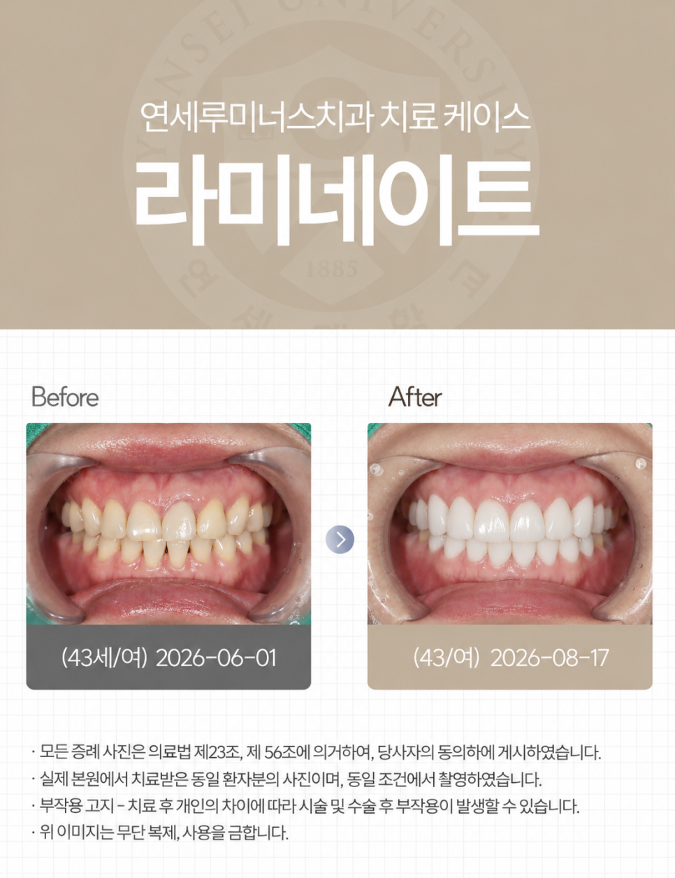 강남라미네이트 / 상악 라미네이트에 이어 하악까지! 완벽 보완 관련 이미지 7