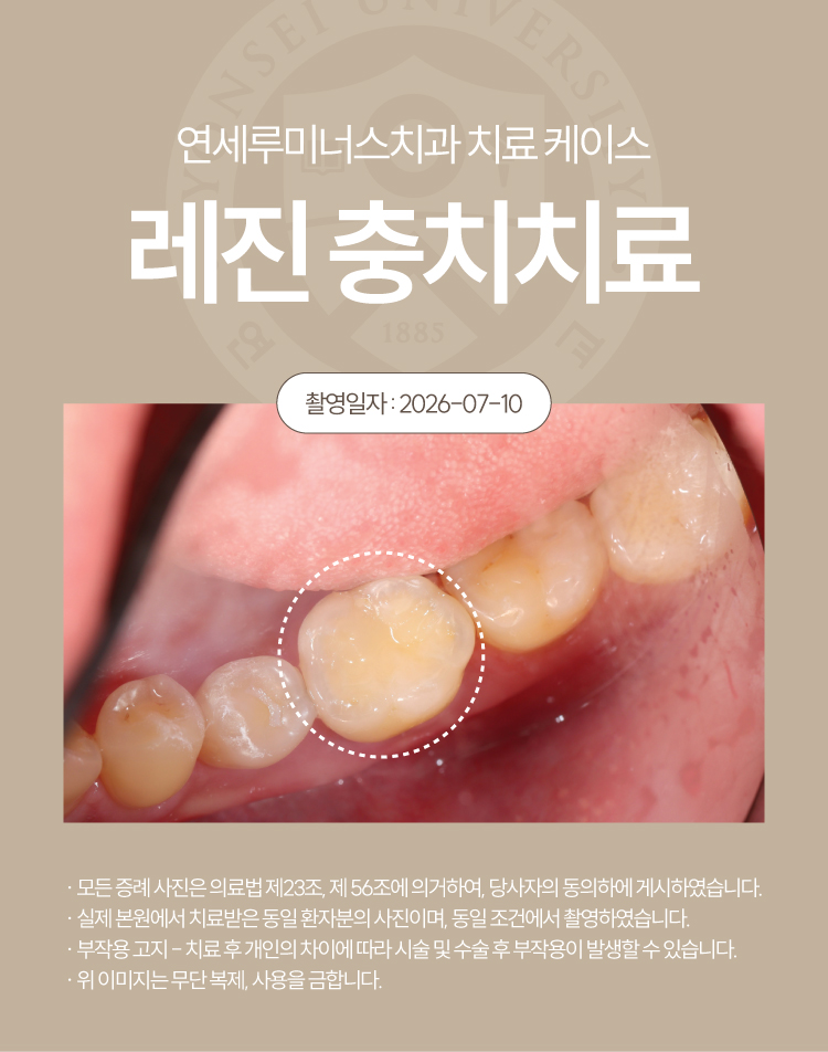 강남충치치료 사례 ― 충치 레진 충전 케이스 (37세/여환자/호주 외국인) 관련 이미지 5