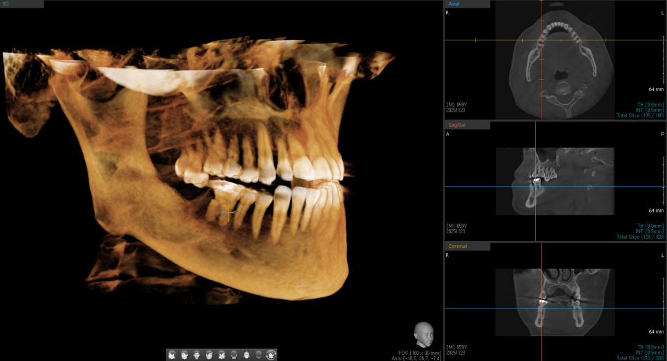 이전에 수술했던 임플란트 케이스 공유합니다! 관련 이미지 1
